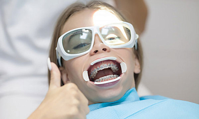 Детям: Снятие несъемной металлической вестибулярной аппаратуры с одного зубного ряда, полирование эмали