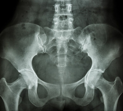 Рентген таза Рентген таза