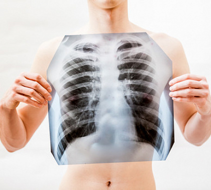 Рентген легких Рентген легких