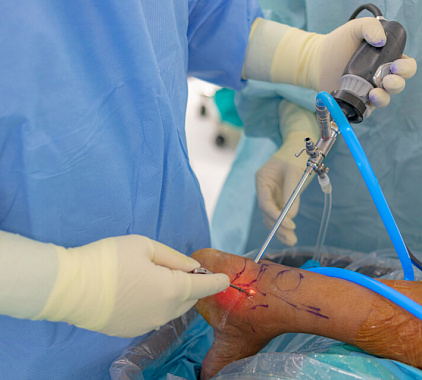 Артроскопия