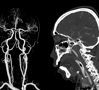 КТ сосудов головного мозга