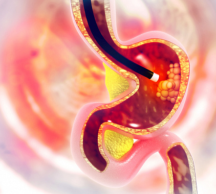 Подготовка к эндоскопии