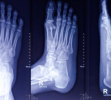 Рентген стопы