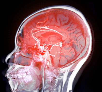 МСКТ сосудов головного мозга