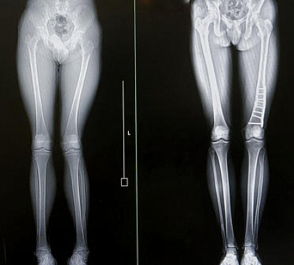 Рентген костей