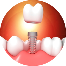Импланты Standard Импланты Standard