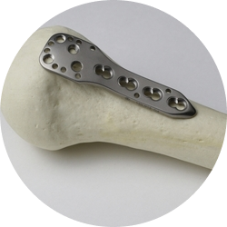 Восстановление и реабилитация после остеосинтеза плечевой кости Восстановление и реабилитация после остеосинтеза плечевой кости