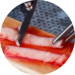 Вестибулопластика