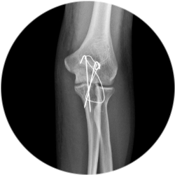 Результат остеосинтеза локтевого отростка 