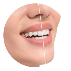 Гингивэктомия 