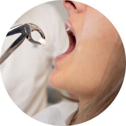 Удаление кисты вместе с зубом