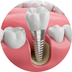 Импланты Bone Level Импланты Bone Level