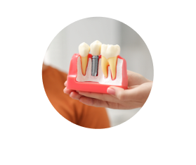 Протез на имплантах Протез на имплантах