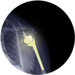 Результат операции эндопротезирования плечевого сустава 