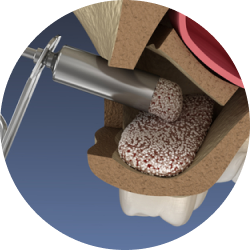 Открытый синус-лифтинг Открытый синус-лифтинг