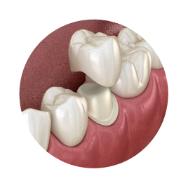 Безметалловые коронки