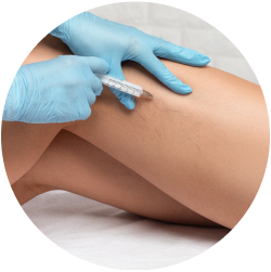 Результат минифлебэктомии