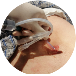 Результат после эпицистостомии