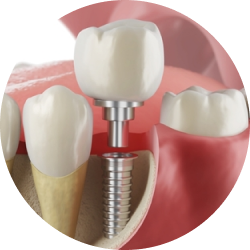 Импланты Standard Plus Импланты Standard Plus