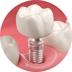 Импланты TS Импланты TS