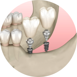 Использование мини-имплантов