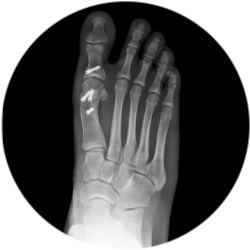 Результат шевронной остеотомии Результат шевронной остеотомии