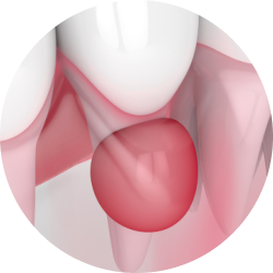 Фолликулярная киста