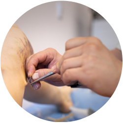 Результат операции Результат РЧА вен