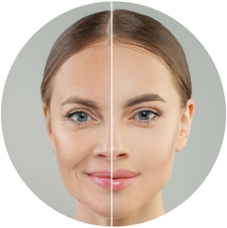 Результат липосакции лица