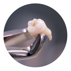 Удаление нижнего зуба мудрости