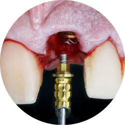 Классическая имплантация Классическая имплантация