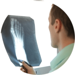 Результат операции корригирующей остеотомии стопы Результат операции корригирующей остеотомии стопы