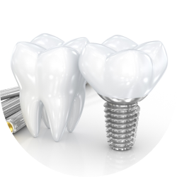 Ипланты Ultra Wide Ипланты Ultra Wide