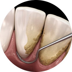 Закрытый кюретаж