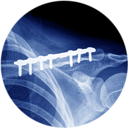 Результат остеосинтеза ключицы Результат остеосинтеза ключицы