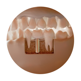 Имплантация зубов без костной пластики
