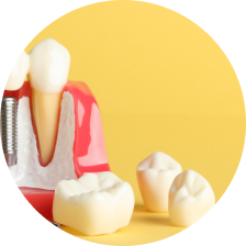 Коронки из композитной пластмассы