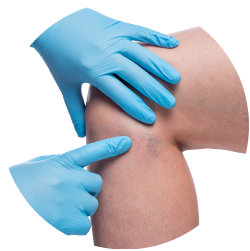 Результат удаления сосудистых звёздочек на ногах лазером