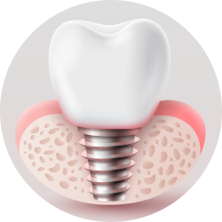Импланты MS Импланты MS