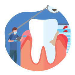 Лечение периодонтита