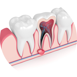 Лечение кист под микроскопом Лечение кист под микроскопом