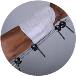 Результат операции остеосинтеза предплечья