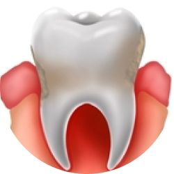 Хронический периодонтит