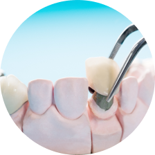 Цельнолитая (монолитная) вкладка Цельнолитая (монолитная) вкладка