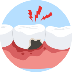 Лечение кариеса Лечение кариеса