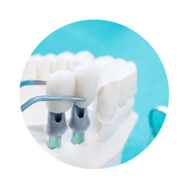 Коронка на имплант Коронка на имплант