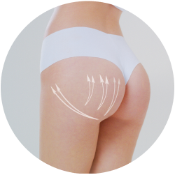 Результат глютеопластики