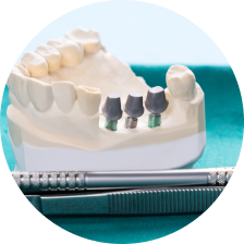 Металлические вкладки Металлические вкладки