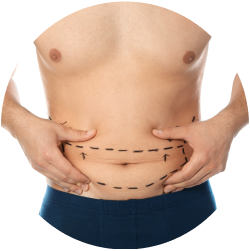 Результат миниабдоминопластики