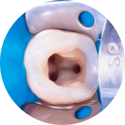 Лечение кариеса под микроскопом Лечение кариеса под микроскопом